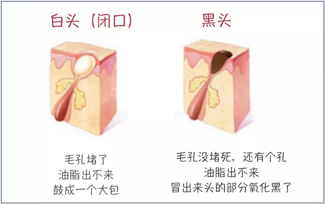怎么去闭口粉刺痘痘脂肪粒,护肤毛孔粗大闭口怎么补救