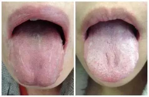 舌头辨体质,看舌头能看出几种体质