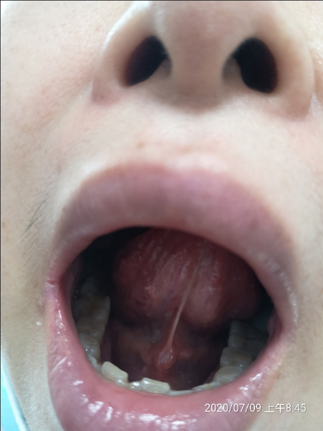 治疗耳石症的五种中成药,有没有治疗耳石症的西药