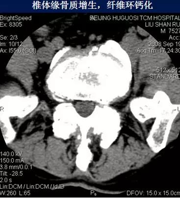 腰椎管狭窄的磁共振诊断标准,腰椎轻度退行性变化椎间盘膨出