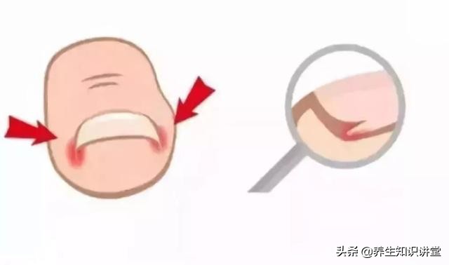 小脚趾甲沟炎自愈的十大方法,脚趾甲长进肉里怎么办修剪视频