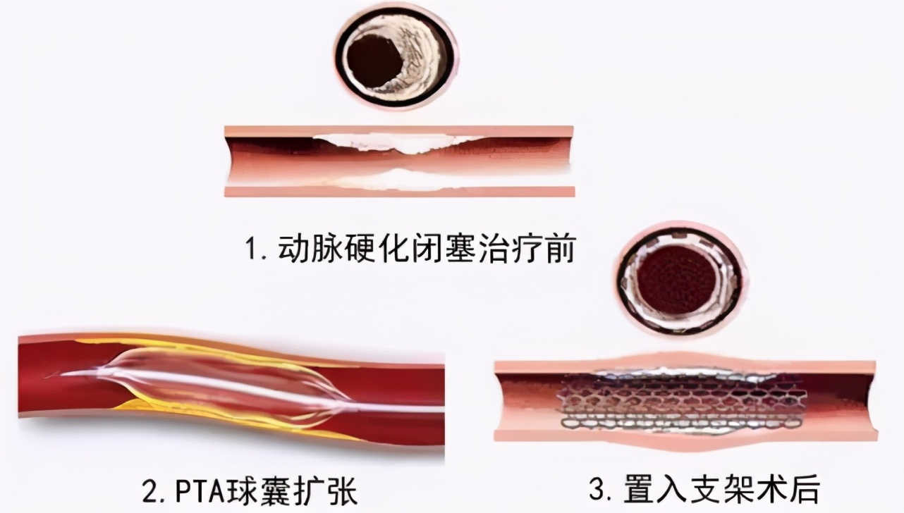 老年人下肢动脉硬化闭塞症症状,高龄老人腿血管闭塞