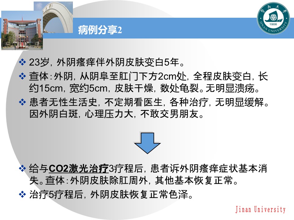 外阴白斑怎么治疗可以激光治疗吗,外阴白斑怎么治疗大概花多少钱