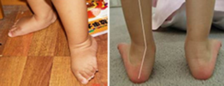 足外翻需要干预么,辟谣矫正腿型足趾环