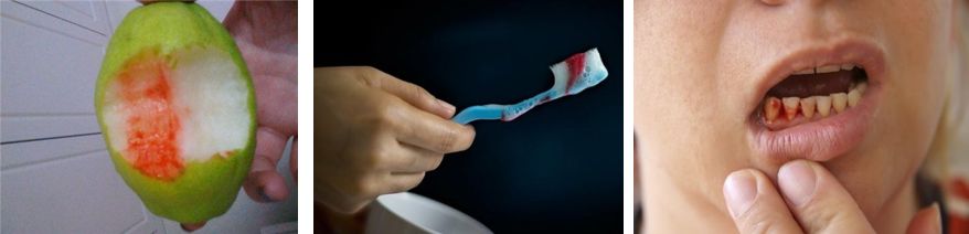 牙龈有血腥气怎么回事,嘴里有血腥味牙龈出血怎么办