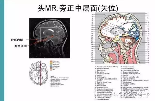 电子版头颅ct与mri断层解剖,头颅mri血管解剖与分段详解