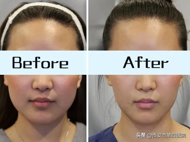 鎵撶槮鑴搁拡鎮勬倓鍙樼編,瀹夊績鍙樼編鐨勪汉閫傚悎鐦﹁劯閽堝悧