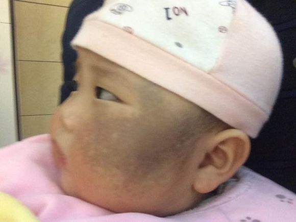 怎样辨别太田痣,婴儿太田痣扩散到几岁能稳定