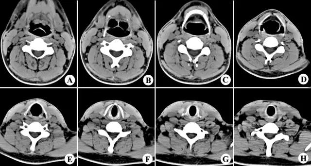 喉部病变做核磁还是ct,耳鼻喉科常见病影像诊断