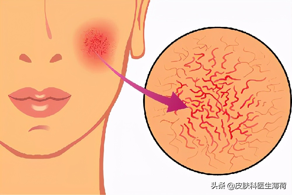 皮肤科医生教你祛痘印,医院的皮肤科主治痘痘痘印吗