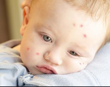 婴儿用的驱蚊和止痒产品推荐,无比滴儿童驱蚊止痒最有效的方法