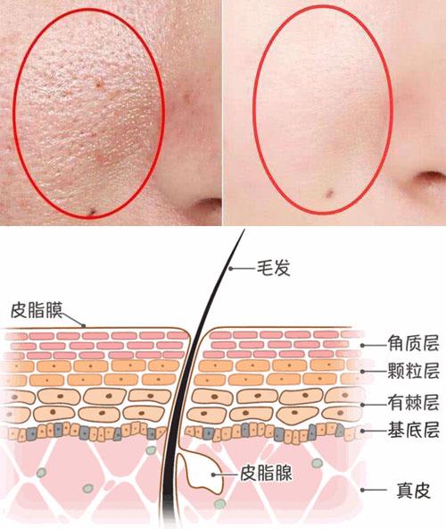 毛孔变大了怎么变成婴儿肌,细嫩婴儿肌从补水开始