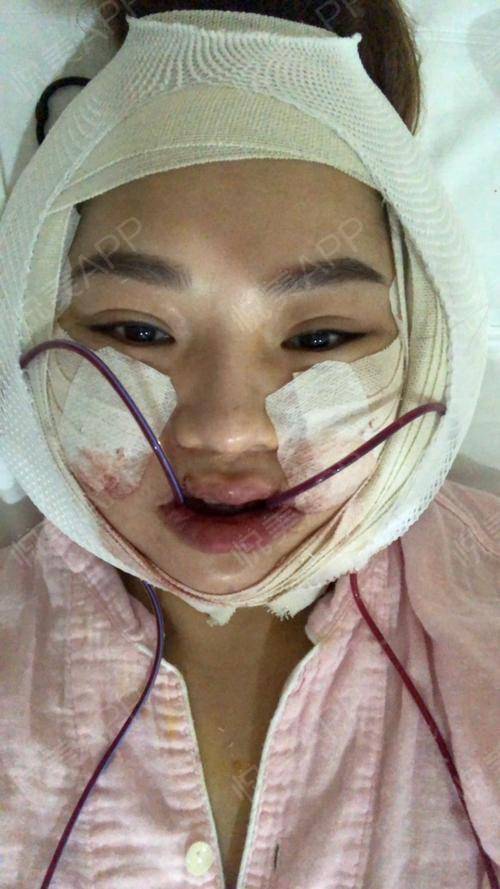 那些削骨的女明星怎么样了,哪些明星承认削骨了