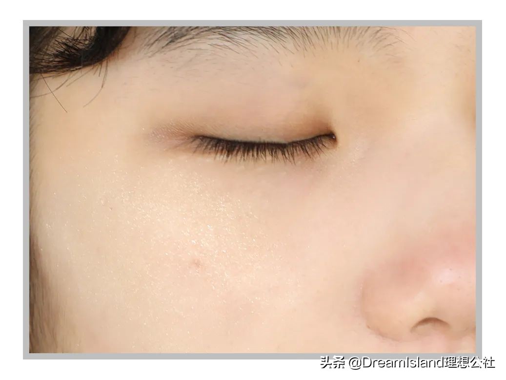 玻尿酸高光排名,打玻尿酸高光推荐