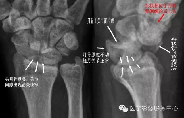 腕骨脱位x线表现,腕骨错位复位手法