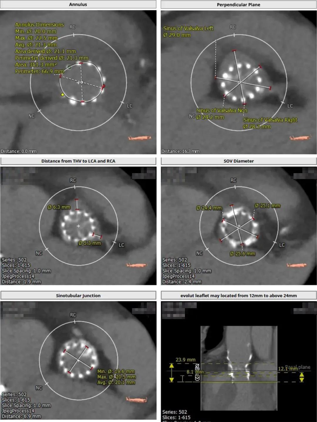 BAV遭遇心脏突然停跳，Sapien3快速植入挽救患者生命