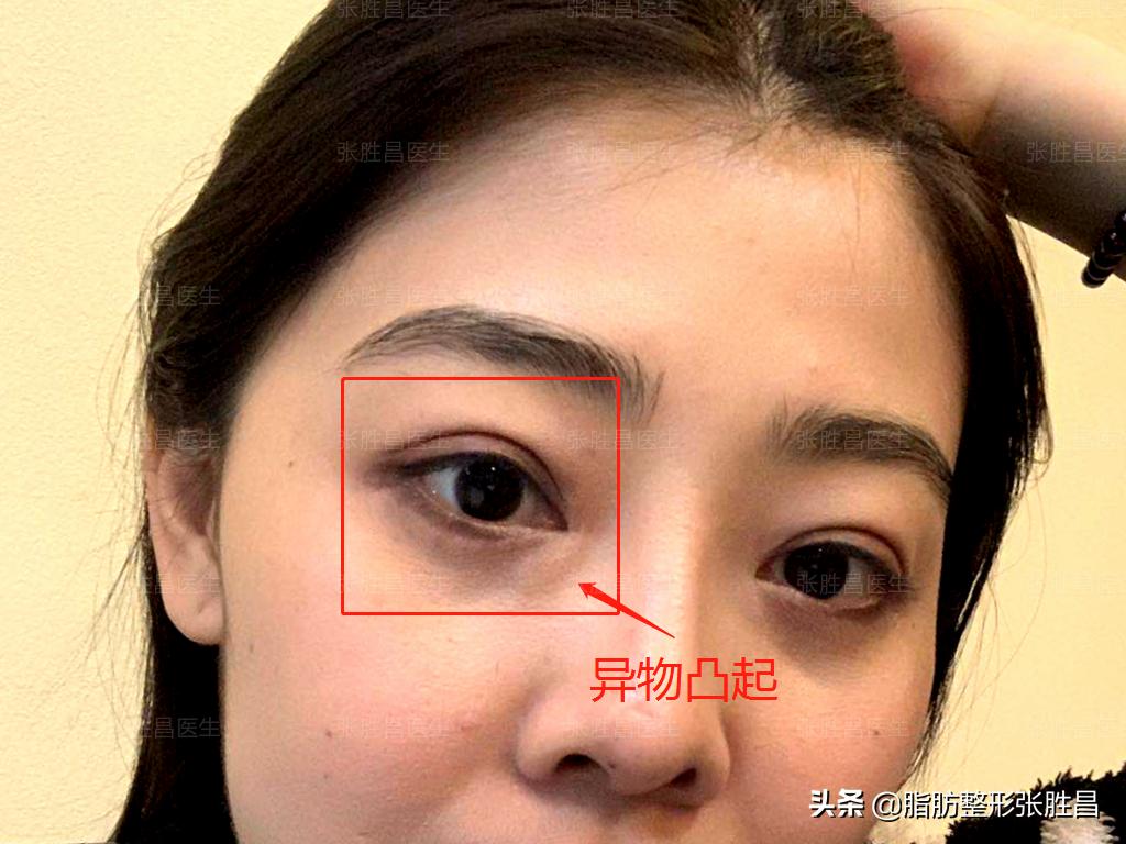 外切眼袋手术后凹陷图片,外切眼袋后怎么感觉特别有整容感