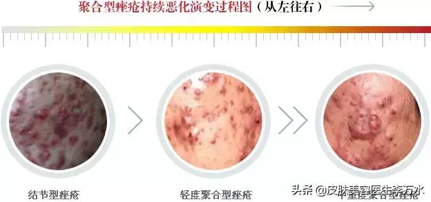 痘痘十大真相,痘痘大全图解