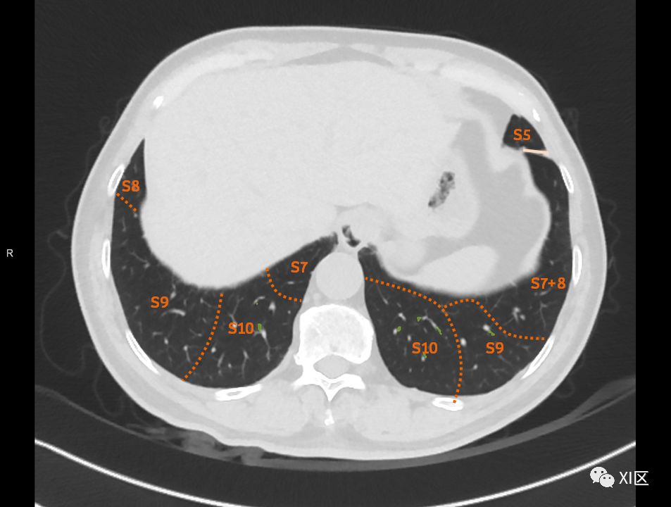 如此详细的肺部影像解剖，有点儿酷