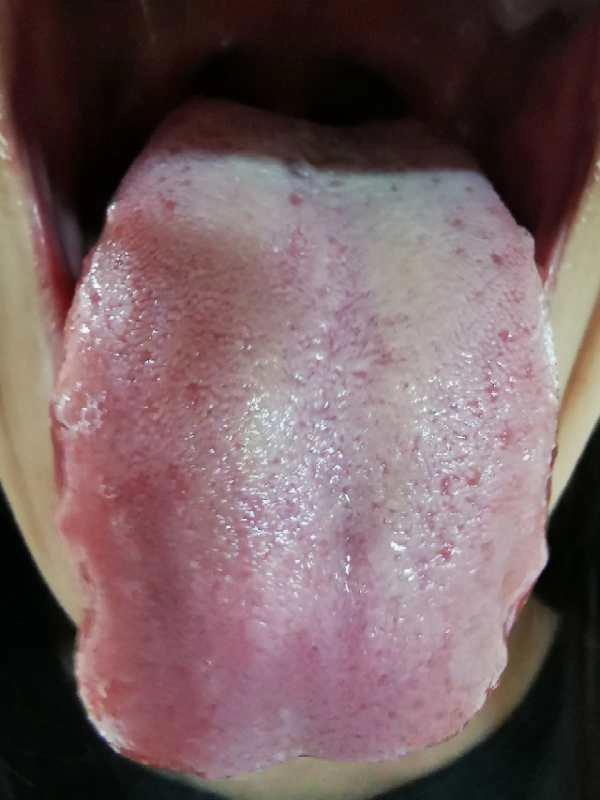 鼻咽炎、阴道炎、乳腺结节、眠差、月经前烦躁，抽丝剥茧找病因