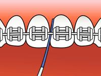 牙套人在学校怎么刷牙,如何戴着牙套正确刷牙