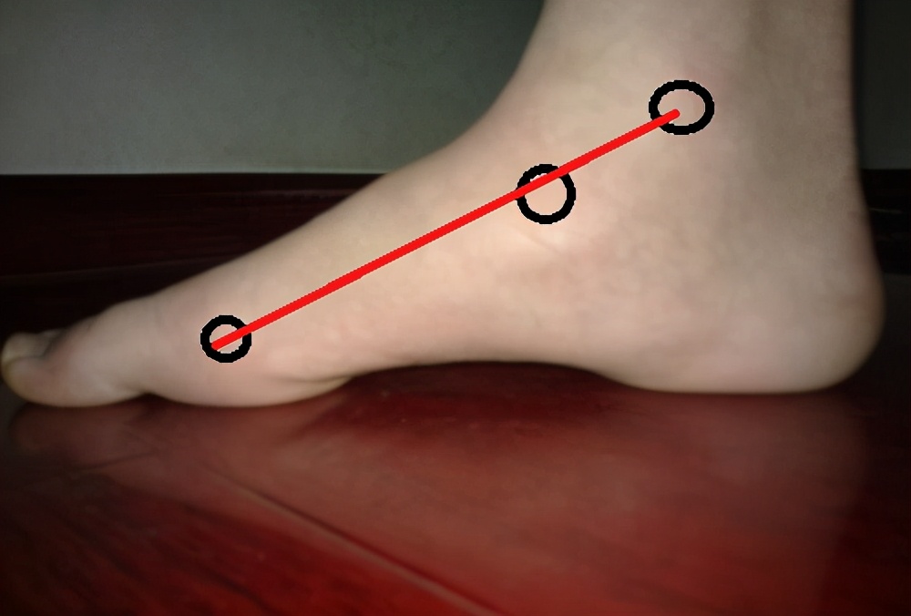 扁平足的腿型怎么改善,扁平足导致腿粗怎么办