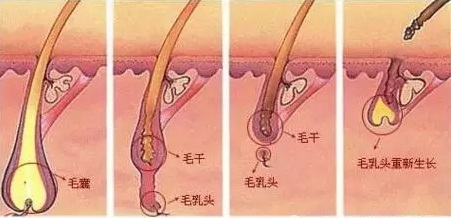 脱发没有毛孔了还能恢复吗,脱发后头发不长了怎么回事