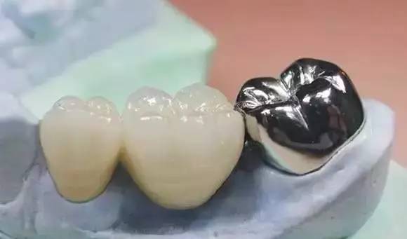 烤瓷牙的危害与副作用,全烤瓷牙有什么风险和后遗症