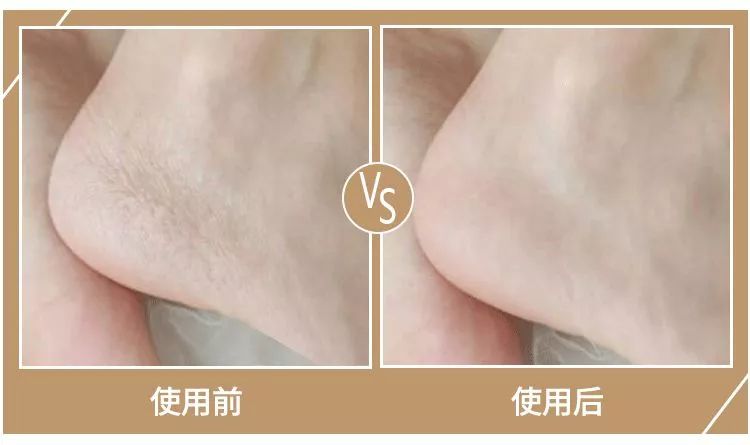 擦手霜保湿干裂起皮,冬季手干裂粗糙小妙招