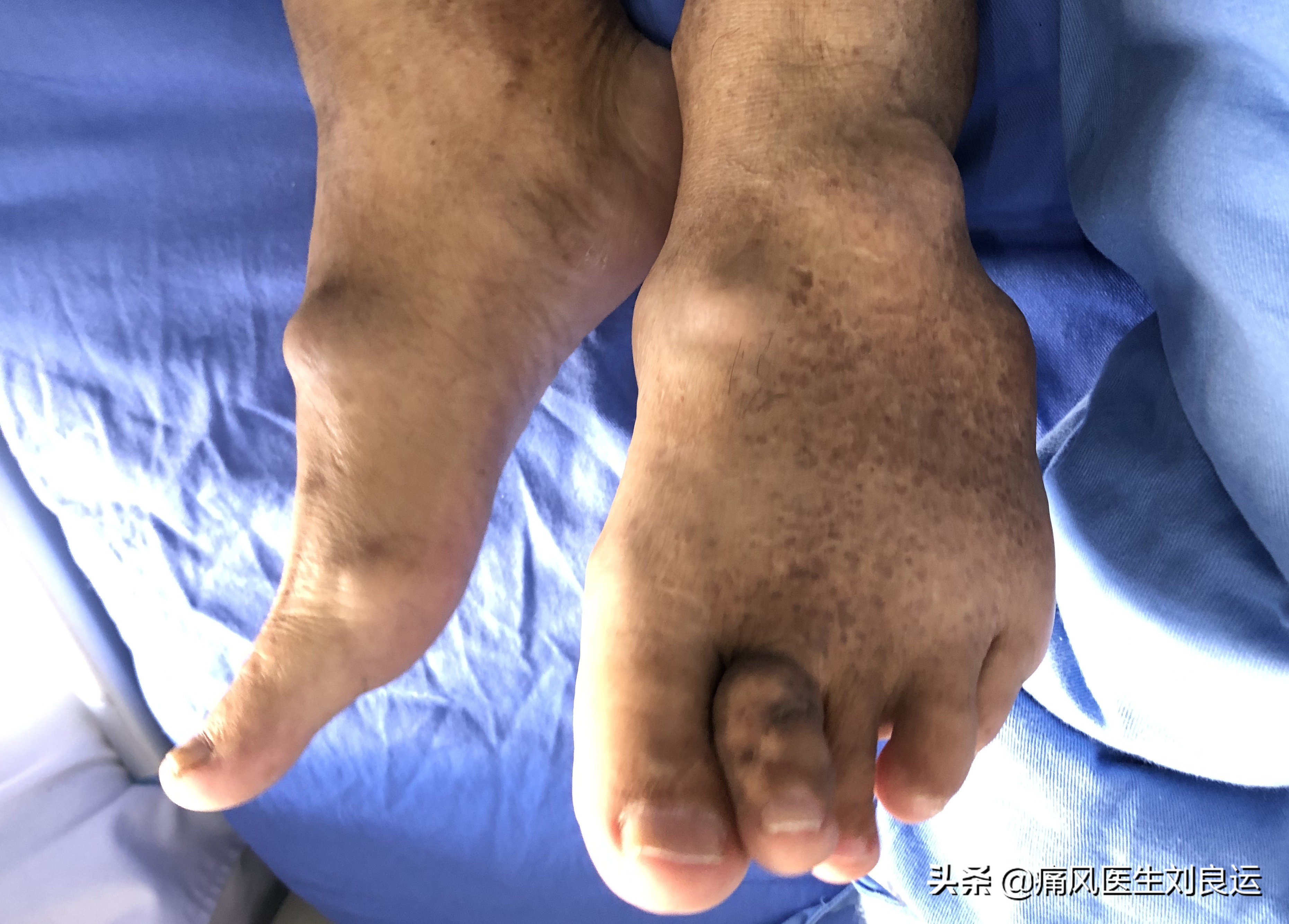 我和我20多年的婚姻，因为痛风20年的丈夫长出痛风石遭遇考验