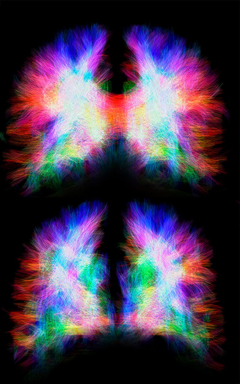 天生智障却创造最强大脑的奇迹,残缺的大脑