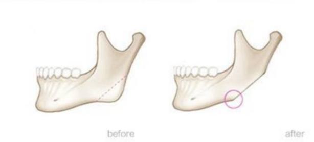 那些削骨的女明星怎么样了,哪些明星承认削骨了