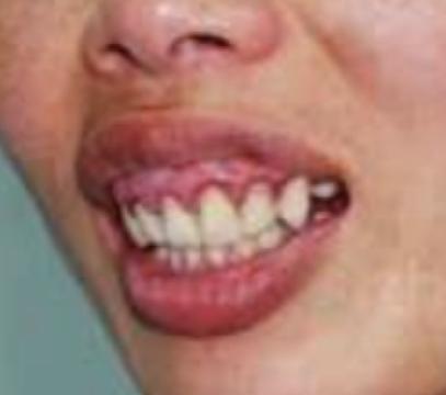 骨性龅牙怎么弄,如何判断骨性龅牙的轻重程度