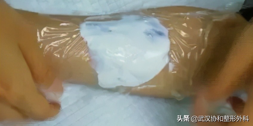 激光洗纹身出血吗,洗纹身是什么体验