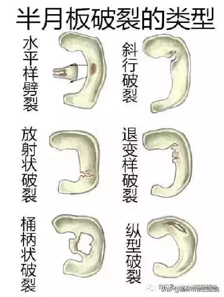 内侧半月板后角损伤怎么治疗,半月板损伤有积液的最好治疗