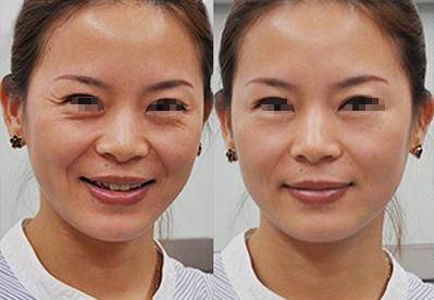 祛颈纹注射除皱和射频除皱哪个好,光电除皱和注射除皱哪个好啊