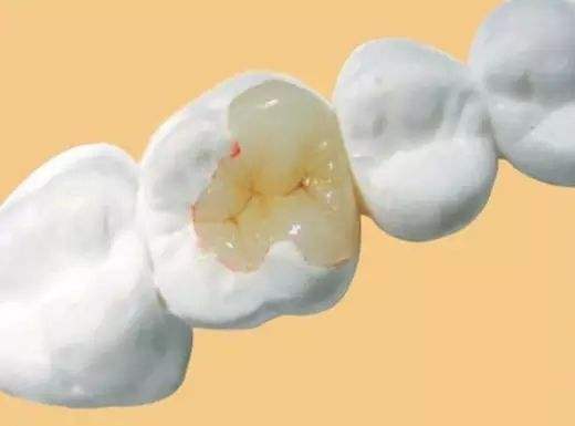 补牙树脂修复牙齿,大连市口腔医院牙齿修复