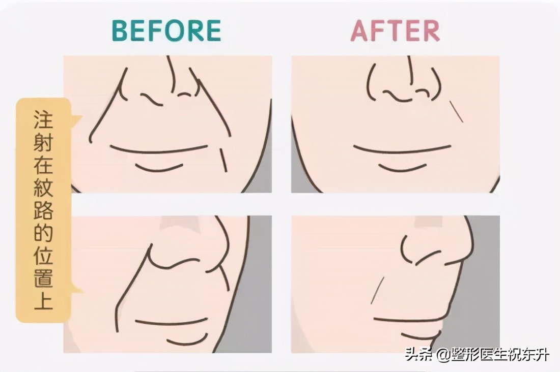 自体脂肪填充法令纹亲身经历,法令纹是不是出现了才能填充