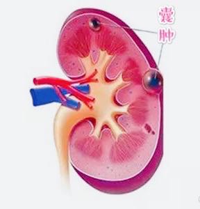 体检查出肾囊肿怎么办,肾囊肿符合体检标准吗