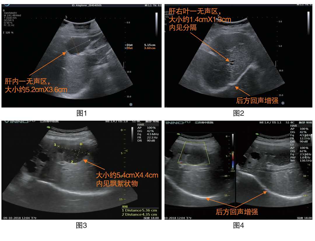 彩超关于肝囊肿的描述,b超说肝血管瘤ct说肝囊肿哪个准确