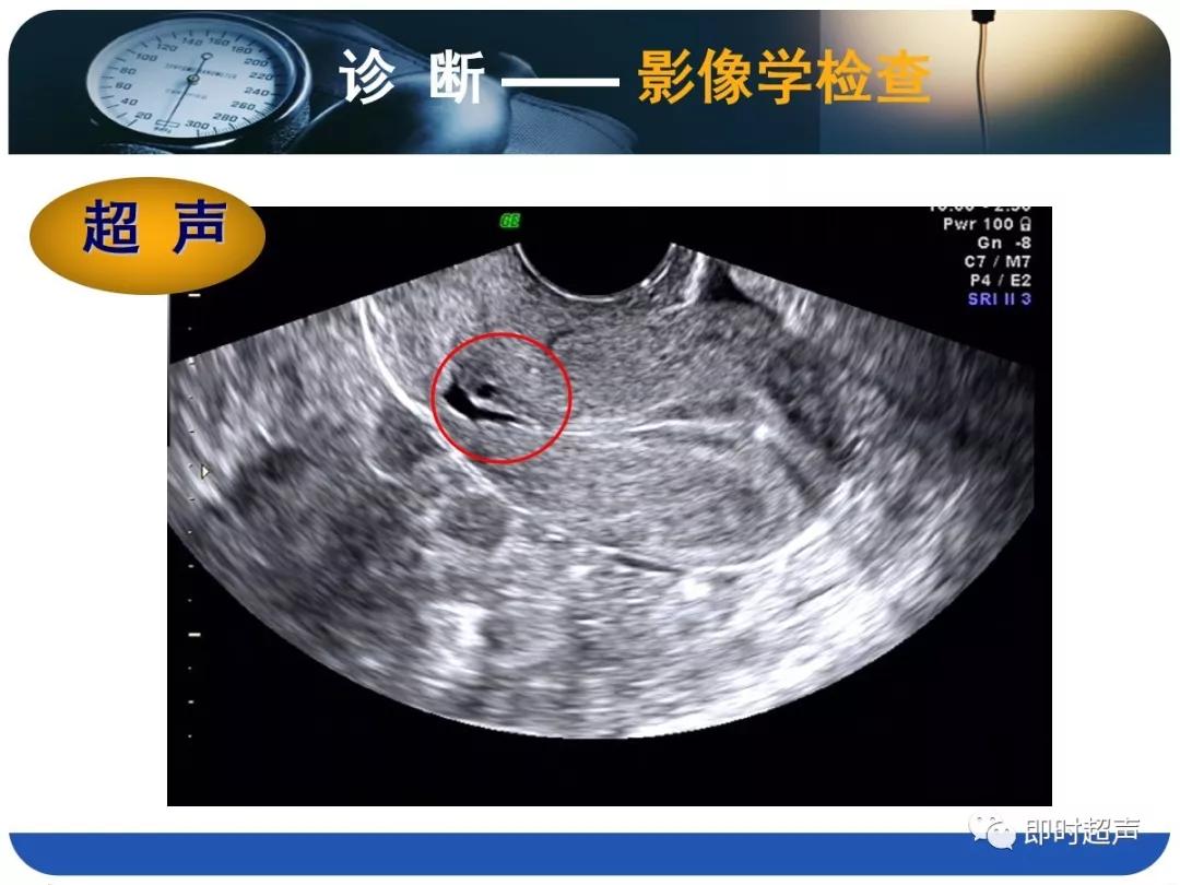 孕妇剖宫产瘢痕憩室,剖宫产瘢痕憩室息肉