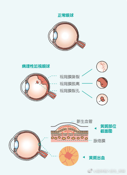 哺光仪能减少近视度数吗,哺光仪对眼轴控制真的有效吗