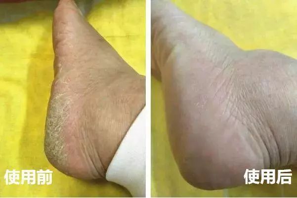 手脚干裂皮肤又厚又痒怎么办,冬天手脚干裂起皮怎么治疗