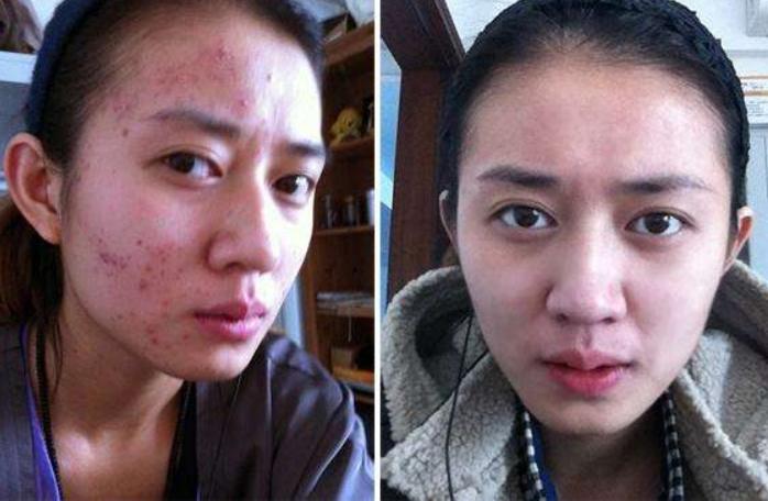 激光祛痘真的能去彻底么,点阵激光祛痘坑痘疤有副作用吗