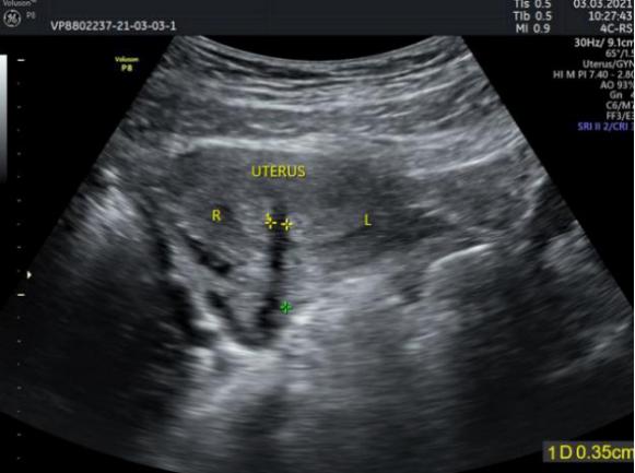 成双成对未必是好事少女双宫颈双阴道腹痛难耐