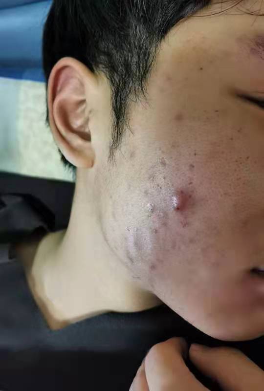 葛根芩连汤治下焦湿热,葛根芩连汤加减治疗湿热医案