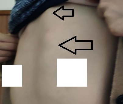 鸡胸微创术后,成年女性鸡胸矫正手术