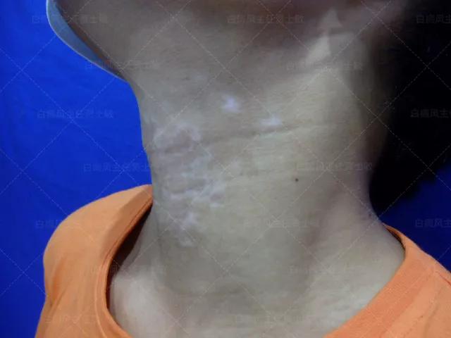 18岁男孩高考备战,18岁男孩白斑