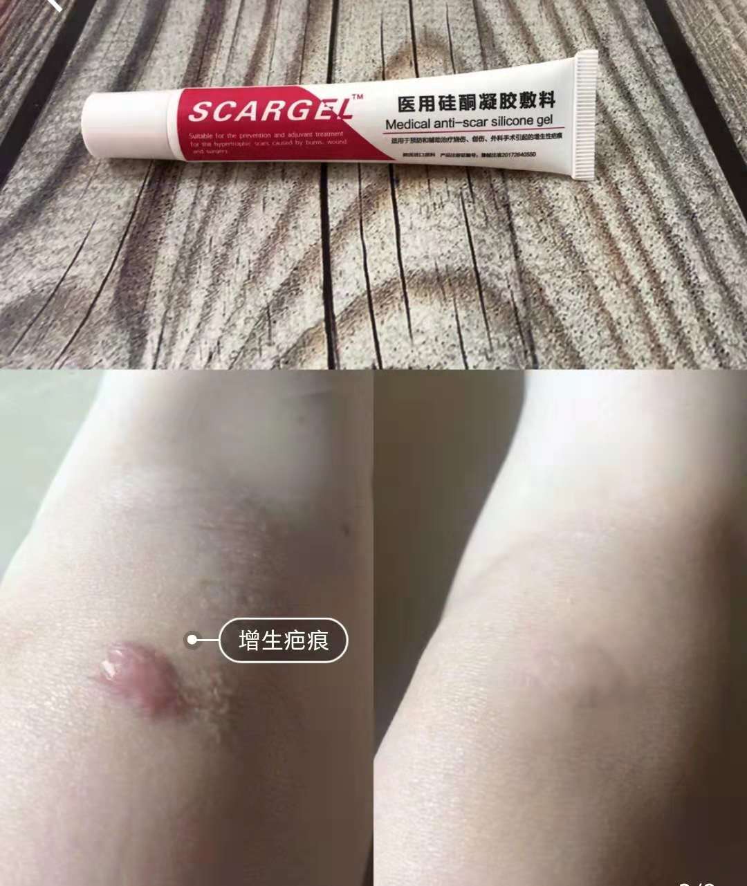 妊娠纹祛疤痕5年了最好的方法,去妊娠纹产后修复排行榜