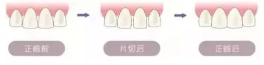 拔牙矫正的真实经历,拔牙矫正后悔的真实案例